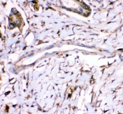 IHC staining of FFPE human intestinal cancer tissue with Annexin A3 antibody. HIER: boil tissue sections in pH8 EDTA for 20 min and allow to cool before testing.