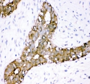 IHC staining of FFPE human breast cancer tissue with Annexin A3 antibody. HIER: boil tissue sections in pH8 EDTA for 20 min and allow to cool before testing.