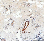 IHC testing of FFPE human breast cancer tissue with Canstatin / Collagen IV antibody at 1ug/ml. Required HIER: steam section in pH8 EDTA buffer for 20 min and allow to cool prior to staining.
