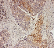 IHC-P: GRB7 antibody testing of human oesophagus squama cancer tissue