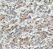 IHC staining of FFPE human breast cancer tissue with MCM3 antibody. HIER: boil tissue sections in pH8 EDTA for 20 min and allow to cool before testing.