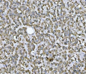 IHC staining of FFPE human liver cancer tissue with SDHB antibody. HIER: boil tissue sections in pH8 EDTA for 20 min and allow to cool before testing.