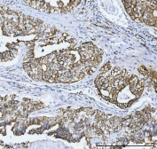 IHC testing of FFPE human lung adenocarcinoma tissue with COX-2 antibody. HIER: boil tissue sections in pH8 EDTA for 20 min and allow to cool before testing.