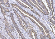 IHC testing of FFPE human colonic adenocarcinoma tissue with COX-2 antibody. HIER: boil tissue sections in pH8 EDTA for 20 min and allow to cool before testing.