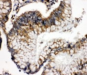 IHC-P: SOD2 antibody testing of human intestinal cancer tissue