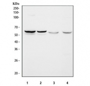 IHC staining of FFPE human breast cancer tissue with SPTLC1 antibody. HIER: boil tissue sections in pH8 EDTA for 20 min and allow to cool before testing.