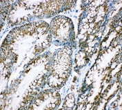 IHC-P: HSP10 antibody testing of human intestinal cancer tissue