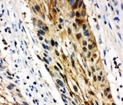 IHC-P: 14-3-3 sigma antibody testing of human oesophagus squama cancer tissue. HIER: boil tissue sections in pH6, 10mM citrate buffer, for 20 min and allow to cool before testing.