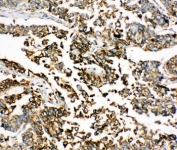 IHC-P: BiP antibody testing of human lung cancer tissue