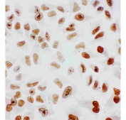 Immunocytochemical staining of FFPE human HeLa cells with Splicing factor 1 antibody. HIER: boil tissue sections in pH6 citrate buffer for 20 min and allow to cool before testing.