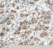 IHC staining of FFPE human breast cancer tissue with MAP3K1 antibody. HIER: boil tissue sections in pH8 EDTA for 20 min and allow to cool before testing.