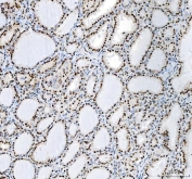 IHC staining of FFPE human thyroid cancer tissue with Nucleophosmin antibody. HIER: boil tissue sections in pH8 EDTA for 20 min and allow to cool before testing.