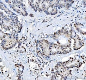 IHC staining of FFPE human colorectal adenocarcinoma tissue with Nucleophosmin antibody. HIER: boil tissue sections in pH8 EDTA for 20 min and allow to cool before testing.