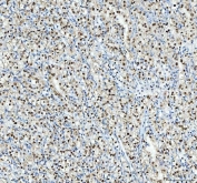 IHC staining of FFPE human glioma tissue with Nucleophosmin antibody. HIER: boil tissue sections in pH8 EDTA for 20 min and allow to cool before testing.