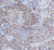 IHC staining of FFPE human ovarian serous adenocarcinoma tissue with TFAM antibody. HIER: boil tissue sections in pH8 EDTA for 20 min and allow to cool before testing.