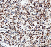 IHC staining of FFPE human liver cancer tissue with TFAM antibody. HIER: boil tissue sections in pH8 EDTA for 20 min and allow to cool before testing.