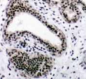 IHC-P: NRF1 antibody testing of human breast cancer tissue