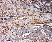 IHC-P: TRPV2 antibody testing of human breast cancer tissue