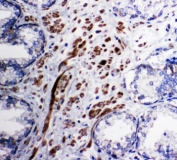 IHC-P: PDK1 antibody testing of human prostatic cancer tissue