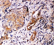 IHC-P: Annexin A10 antibody testing of human lung cancer tissue