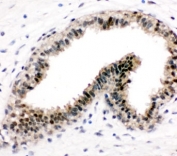 IHC-P: VCP antibody testing of human breast cancer tissue