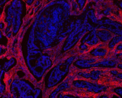 Immunofluorescent staining of FFPE human breast tissue with Collagen 1 antibody (red) and DAPI counterstain (blue). HIER: boil tissue sections in pH6 citrate buffer for 10-20 min and allow to cool before testing.