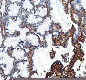 IHC staining of FFPE human lung adenocarcinoma tissue with Collagen 1 antibody, HRP secondary and DAB substrate. HIER: boil tissue sections in pH8 EDTA for 20 min and allow to cool before testing.