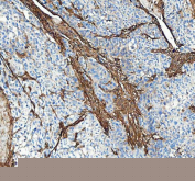 IHC staining of FFPE human bladder urothelial carcinoma tissue with Collagen 1 antibody, HRP secondary and DAB substrate. HIER: boil tissue sections in pH8 EDTA for 20 min and allow to cool before testing.