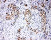 IHC-P: beta Arrestin 1 antibody testing of human breast cancer tissue