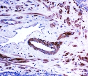 IHC-P: ACE antibody testing of human prostate cancer tissue