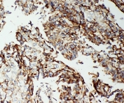 IHC-P: Apoptosis-Inducing Factor antibody testing of human lung cancer tissue