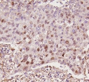 IHC staining of FFPE human lung cancer tissue with p53 antibody. HIER: boil tissue sections in pH8 EDTA for 20 min and allow to cool before testing.