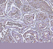 IHC staining of FFPE human colon cancer tissue with Annexin V antibody, HRP-labeled secondary and DAB substrate. HIER: boil tissue sections in pH8 EDTA for 20 min and allow to cool before testing.