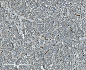 IHC staining of FFPE human lymphoma with CD34 antibody. HIER: boil tissue sections in pH8 EDTA for 20 min and allow to cool before testing.