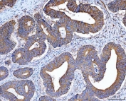 IHC staining of FFPE human rectal cancer tissue with Src antibody. HIER: boil tissue sections in pH8 EDTA for 20 min and allow to cool before testing.