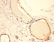 IHC-P: VWF antibody testing of human lung cancer tissue. HIER: steam section in pH6 citrate buffer for 20 min and allow to cool prior to testing.