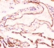 IHC-P: Collagen IV antibody testing of human lung cancer tissue. HIER: boil tissue sections in pH6, 10mM citrate buffer, for 10-20 min and allow to cool before testing.