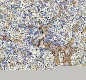 IHC staining of FFPE human testis cancer tissue with AAMP antibody, HRP-labeled secondary and DAB substrate. HIER: boil tissue sections in pH8 EDTA for 20 min and allow to cool before testing.