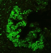 Immunofluorescent staining of FFPE human colon cancer tissue with APE1 antibody. HIER: steam section in pH6 citrate buffer for 20 min.