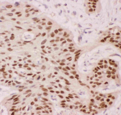 IHC staining of FFPE human esophagus squama cancer tissue with p63 antibody, HRP-secondary and DAB substrate. HIER: boil tissue sections in pH8 EDTA for 20 min and allow to cool before testing.