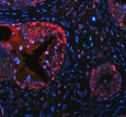Immunofluorescent staining of FFPE human prostate hyperplasia tissue with p63 antibody (red) and DAPI nuclear stain (blue). HIER: steam section in pH8 EDTA buffer for 20 min.