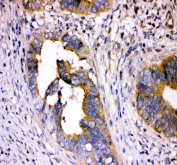 IHC staining of FFPE human colorectal cancer tissue with DHFR antibody. HIER: boil tissue sections in pH8 EDTA for 20 min and allow to cool before testing.