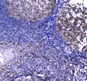 IHC staining of FFPE human tonsil tissue with Caspase-3 antibody. HIER: boil tissue sections in pH8 EDTA for 20 min and allow to cool before testing.