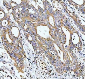 IHC staining of FFPE human colorectal cancer tissue with GCLC antibody. HIER: boil tissue sections in pH8 EDTA for 20 min and allow to cool before testing.