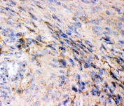 IHC staining of FFPE human meningioma tissue with GLUR1 antibody, HRP-secondary and DAB substrate. HIER: boil tissue sections in pH8 EDTA for 20 min and allow to cool before testing.