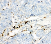IHC-P: HEXB antibody testing of human lung cancer tissue