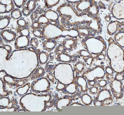 IHC staining of FFPE human thyroid cancer tissue with Heme Oxygenase 2 antibody. HIER: boil tissue sections in pH8 EDTA buffer for 20 min and allow to cool before testing.