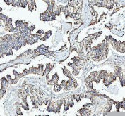 IHC staining of FFPE human lung adenocarcinoma tissue with Heme Oxygenase 2 antibody. HIER: boil tissue sections in pH6 citrate buffer for 20 min and allow to cool before testing.