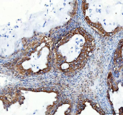IHC staining of FFPE human ovarian serous adenocarcinoma tissue with Heme Oxygenase 2 antibody. HIER: boil tissue sections in pH8 EDTA buffer for 20 min and allow to cool before testing.