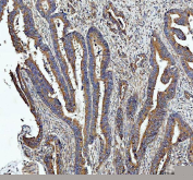 IHC staining of FFPE human colorectal adenocarcinoma tissue with Heme Oxygenase 2 antibody. HIER: boil tissue sections in pH8 EDTA buffer for 20 min and allow to cool before testing.